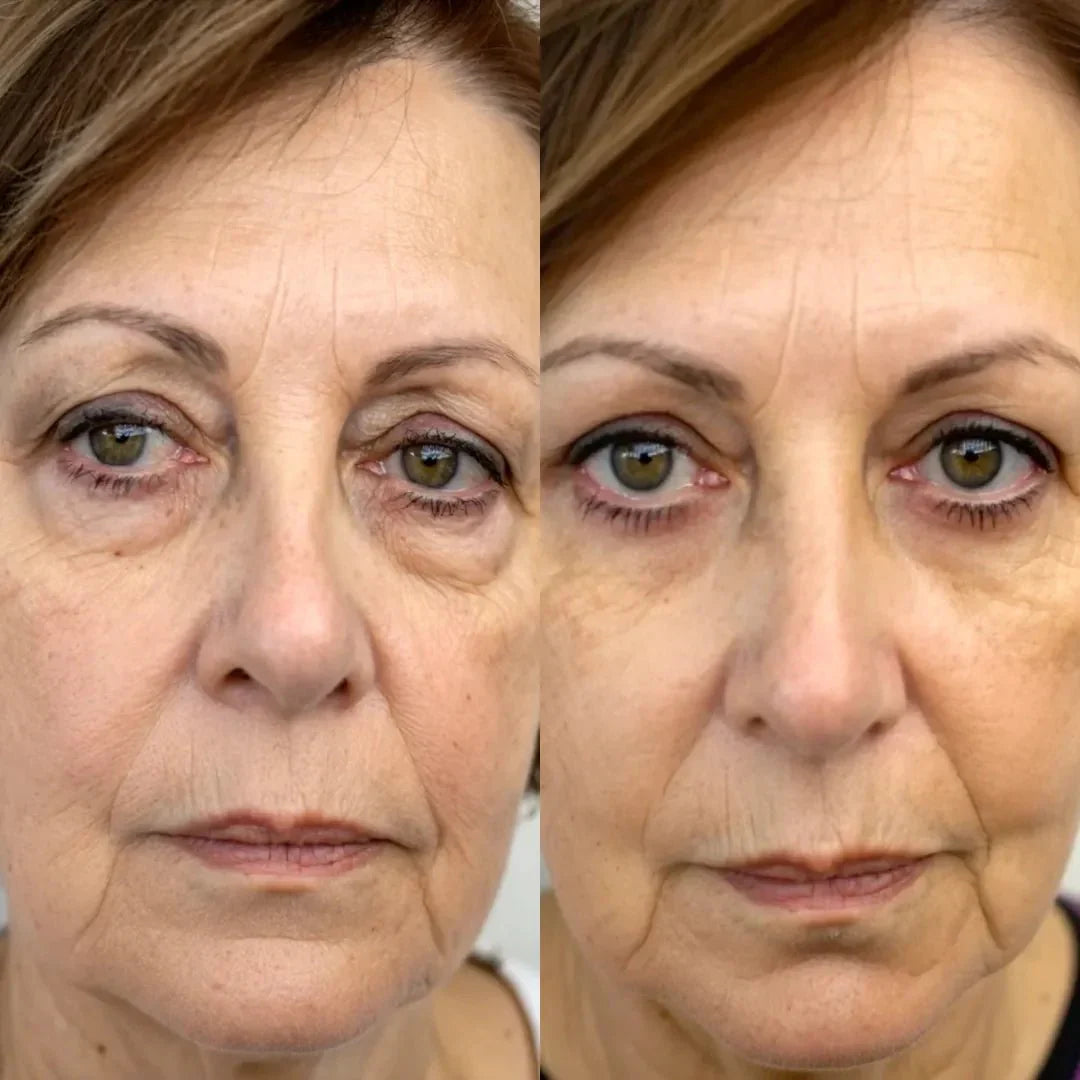 RevitalEyes® 2-en-1 contre les Poches Sous les Yeux