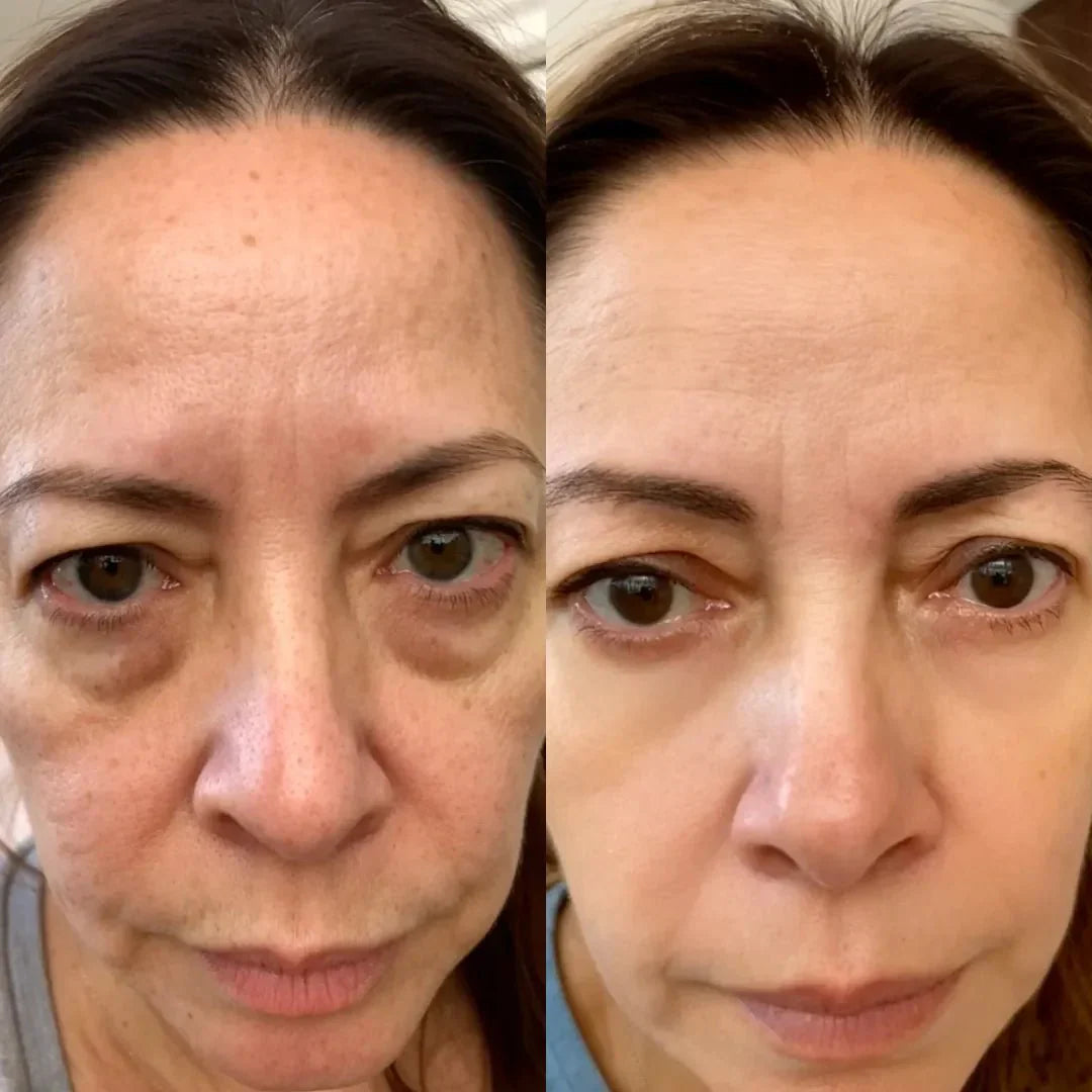RevitalEyes® 2-en-1 contre les Poches Sous les Yeux